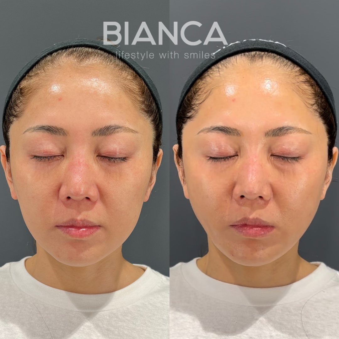 ダウンタイムも軽い　BIANCAリフト４本