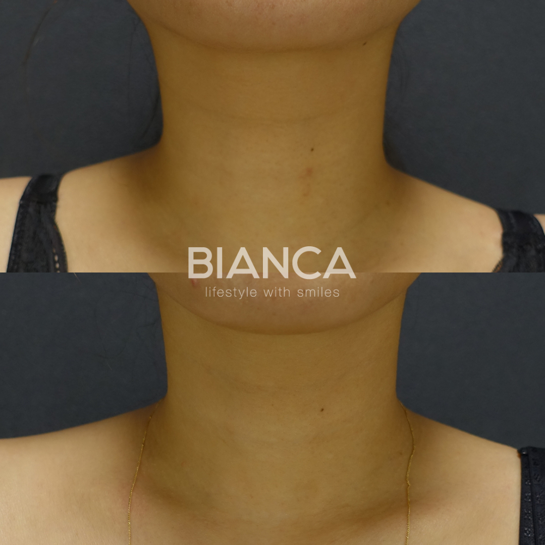 首のシワ撃退「Volite」で深めのミゾを 「Hydro」で細かいシワを