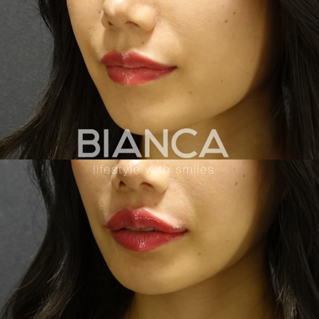 更なる美人へ　デザインヒアルロン酸（唇）