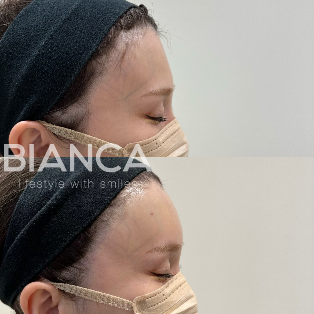 直後でここまで変わる　ヒアルロン酸(額)