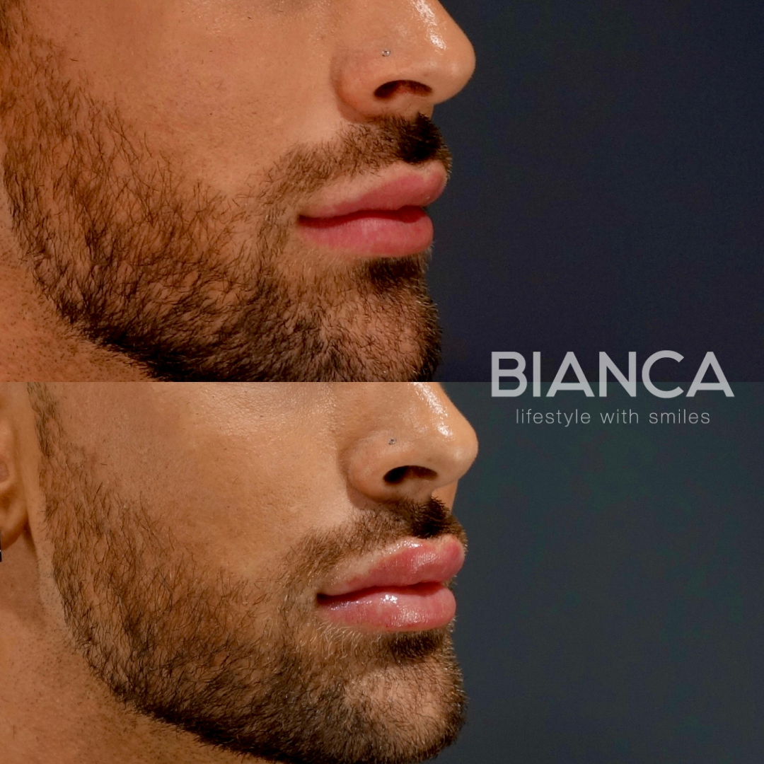 ロシアンリップ　唇ヒアルロン酸