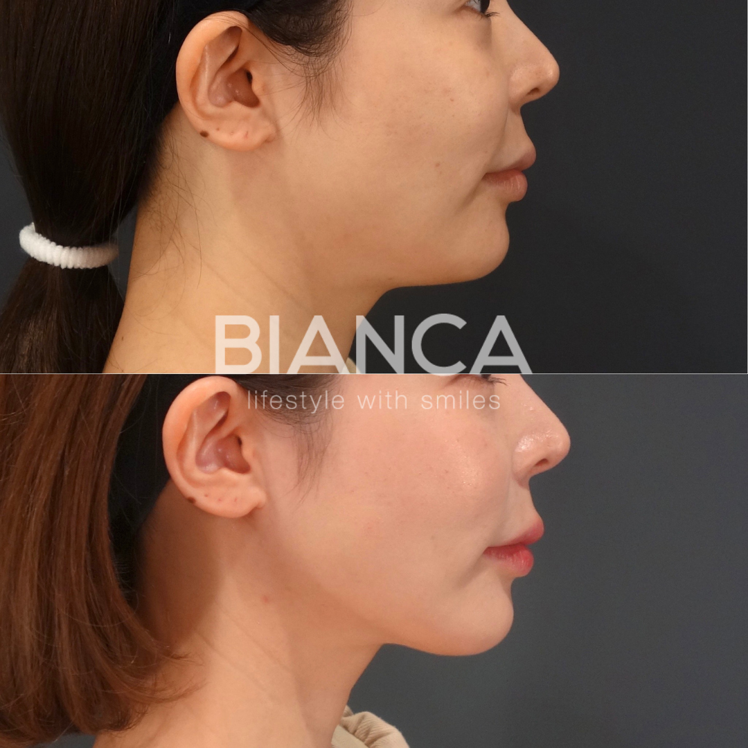 BIANCA LIFT４本とBIANCA LIFT W２本