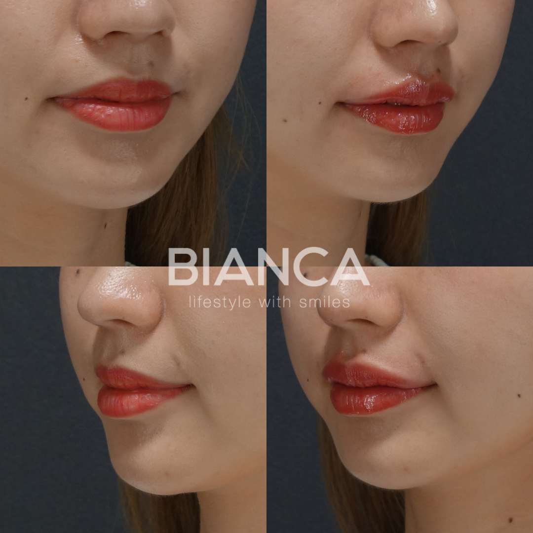 ヒアルロン酸で速攻、更なる美人へ　（直後）