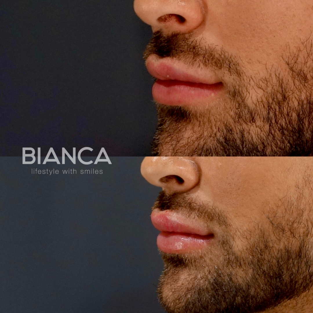 ロシアンリップ 唇ヒアルロン酸