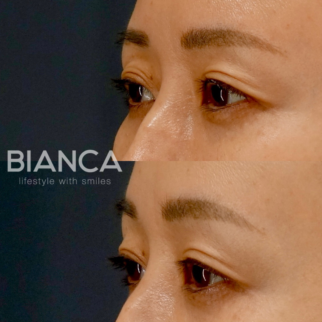 ヒアルロン酸注入でダウンタイムは短く、目の上の窪みを改善