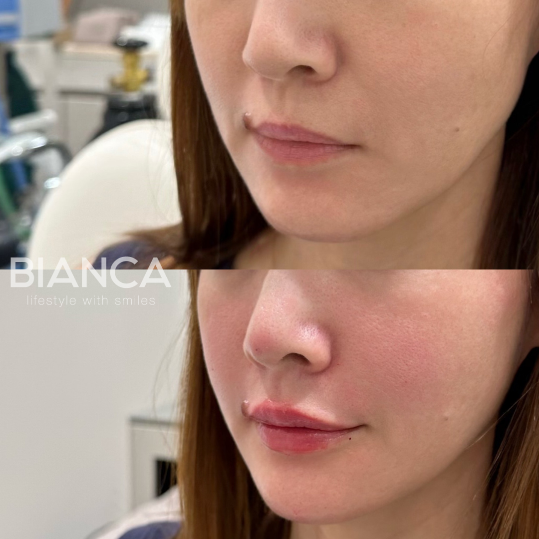 唇ヒアルロン酸で憧れのぷるぷるロシアンリップ