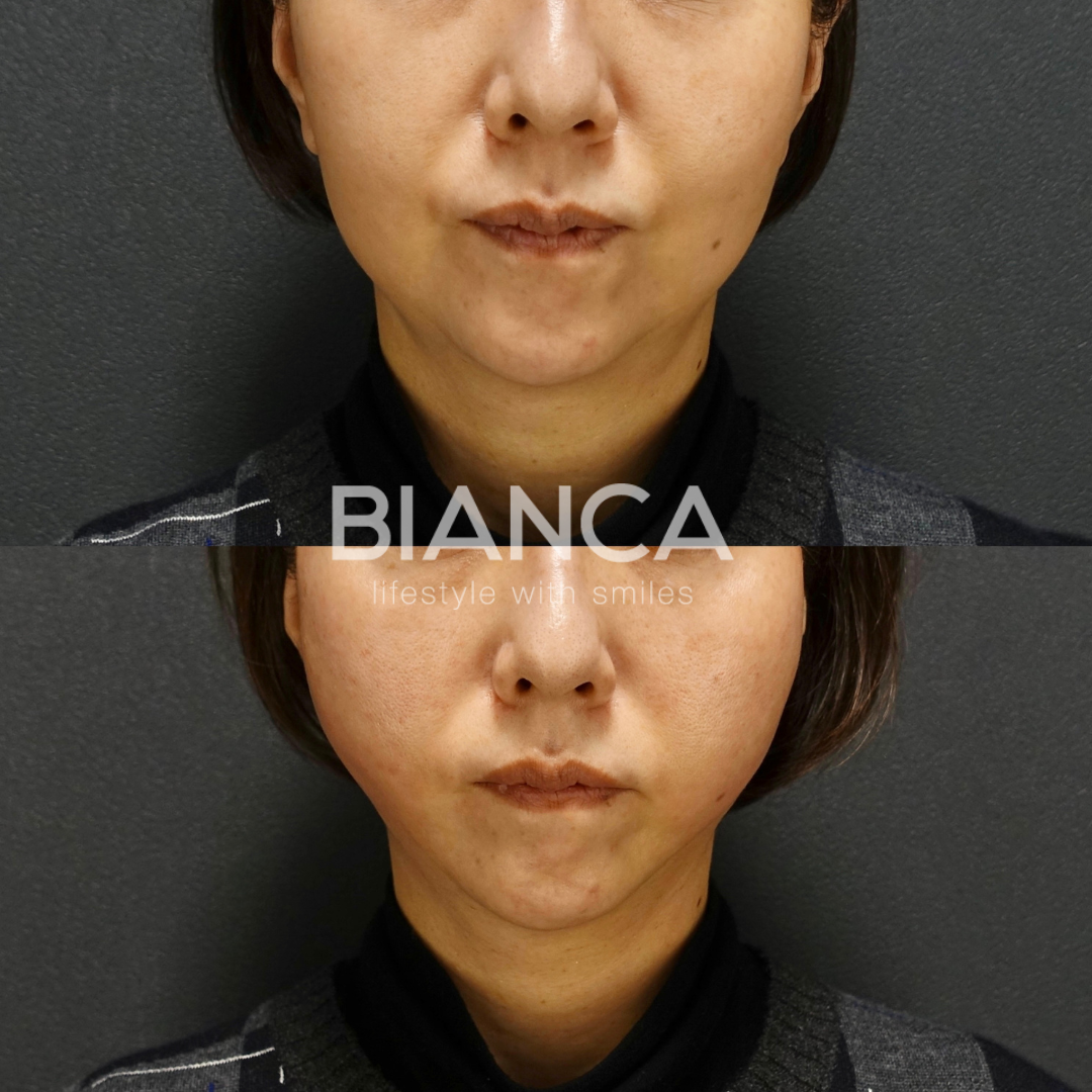 一人一人に合わせたBIANCALIFT　10本