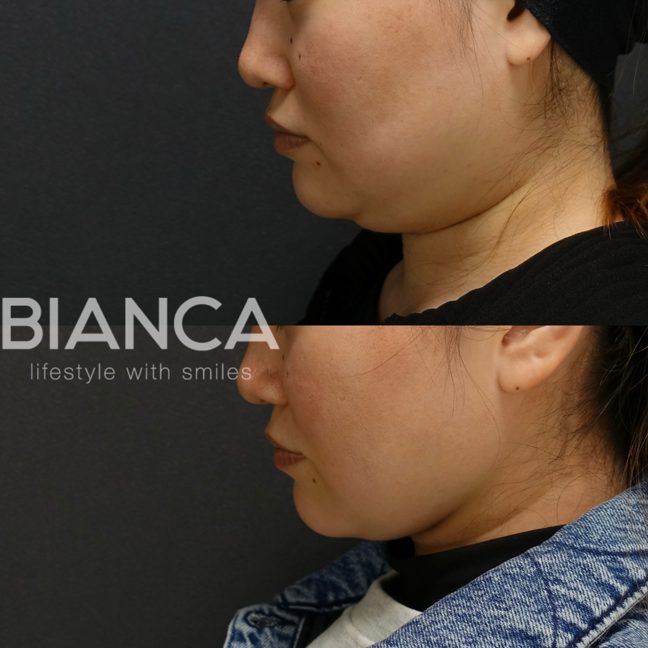 フェイスライン（頬顎下）脂肪吸引✖BIANCALIFT6本（術後1ヶ月）