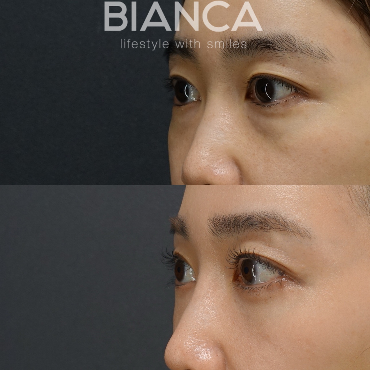 裏ハムラ法(経結膜眼窩脂肪移動術)