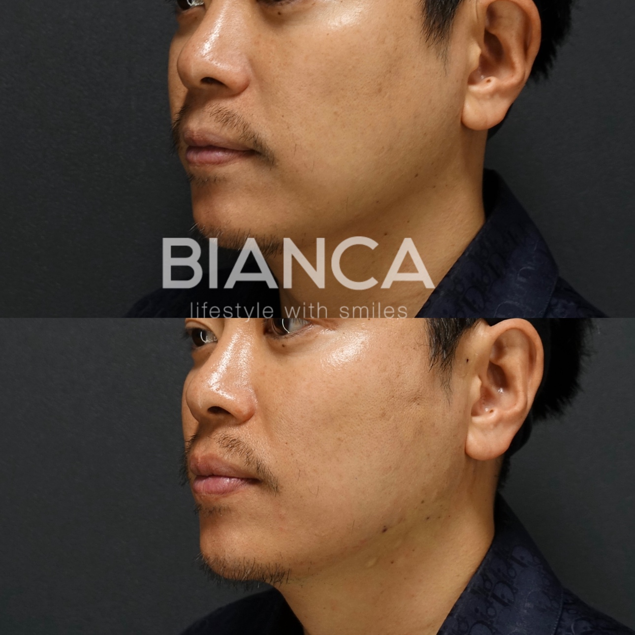 カスタムリフト (BIANCA LIFT 6本,BIANCA LIFT W 1本,ミニスレッド40本)