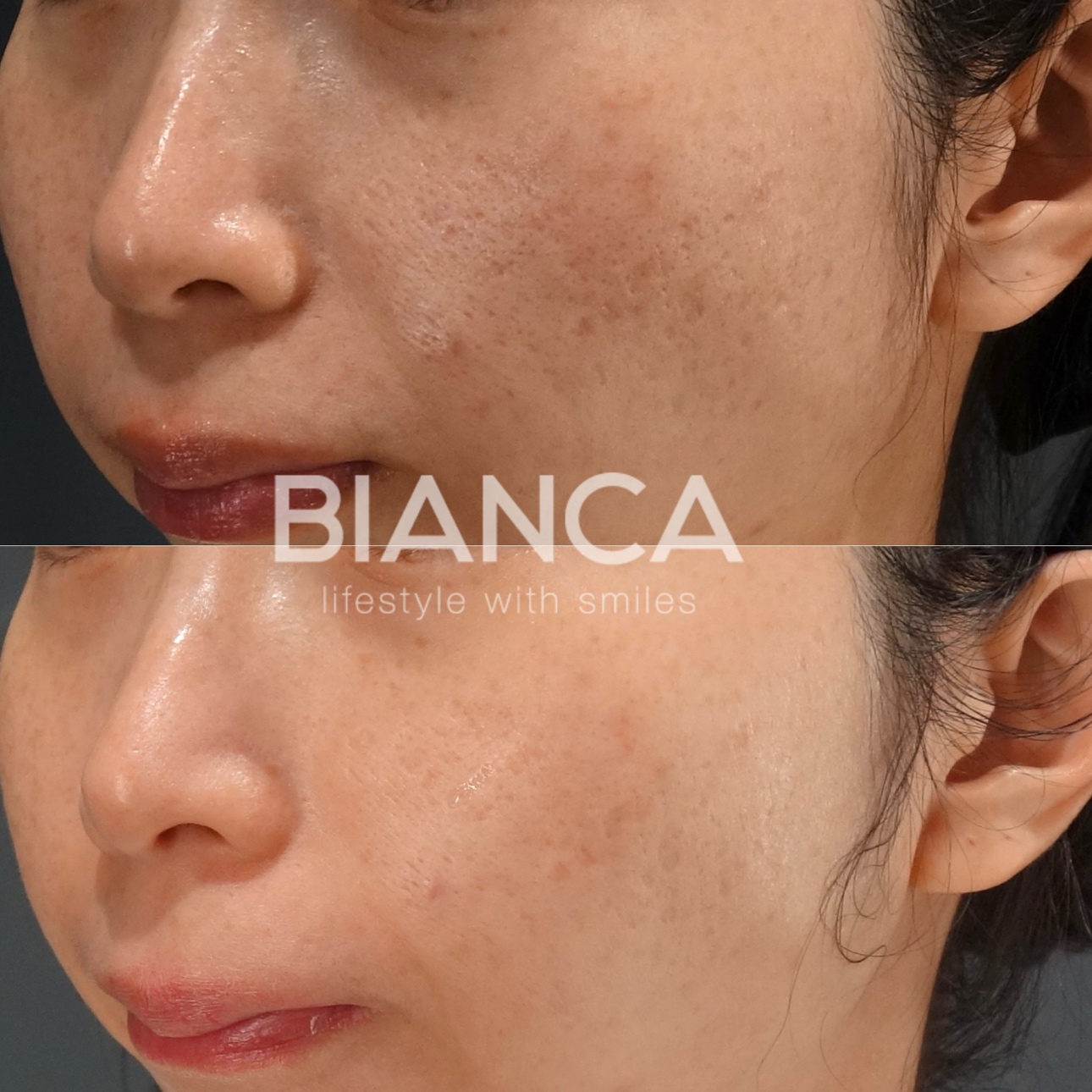 韓国で爆発的にブームの施術　ジュベルック施術1回1ヶ月後