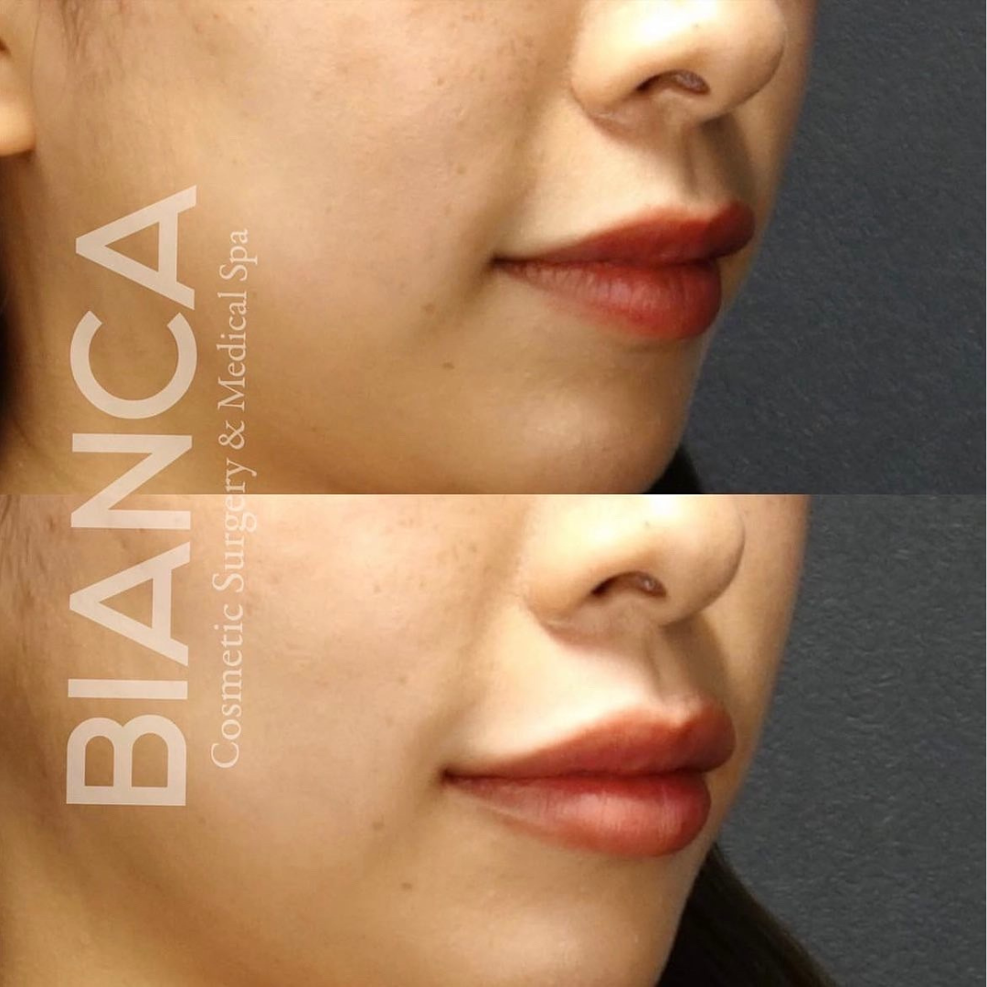 唇ヒアルロン酸で人中を短く魅せる