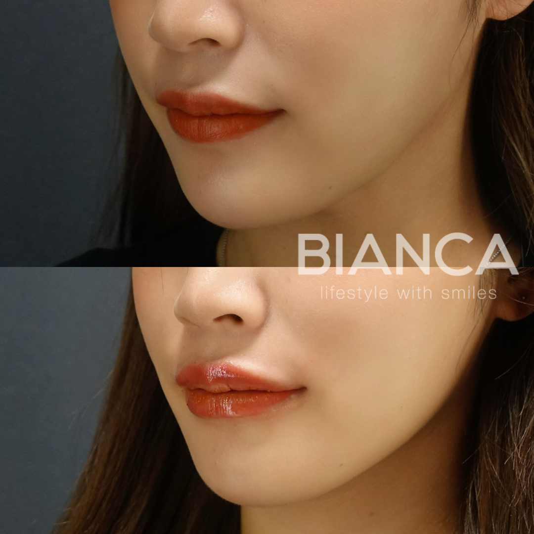 唇ヒアルロン酸で美リップに