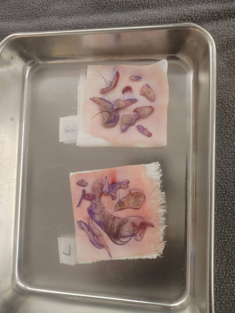 フェイスリフト　皮膚切除量