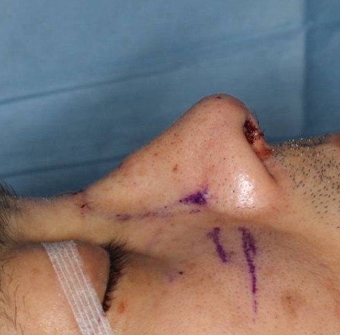 鼻中隔延長、鼻尖形成の中身