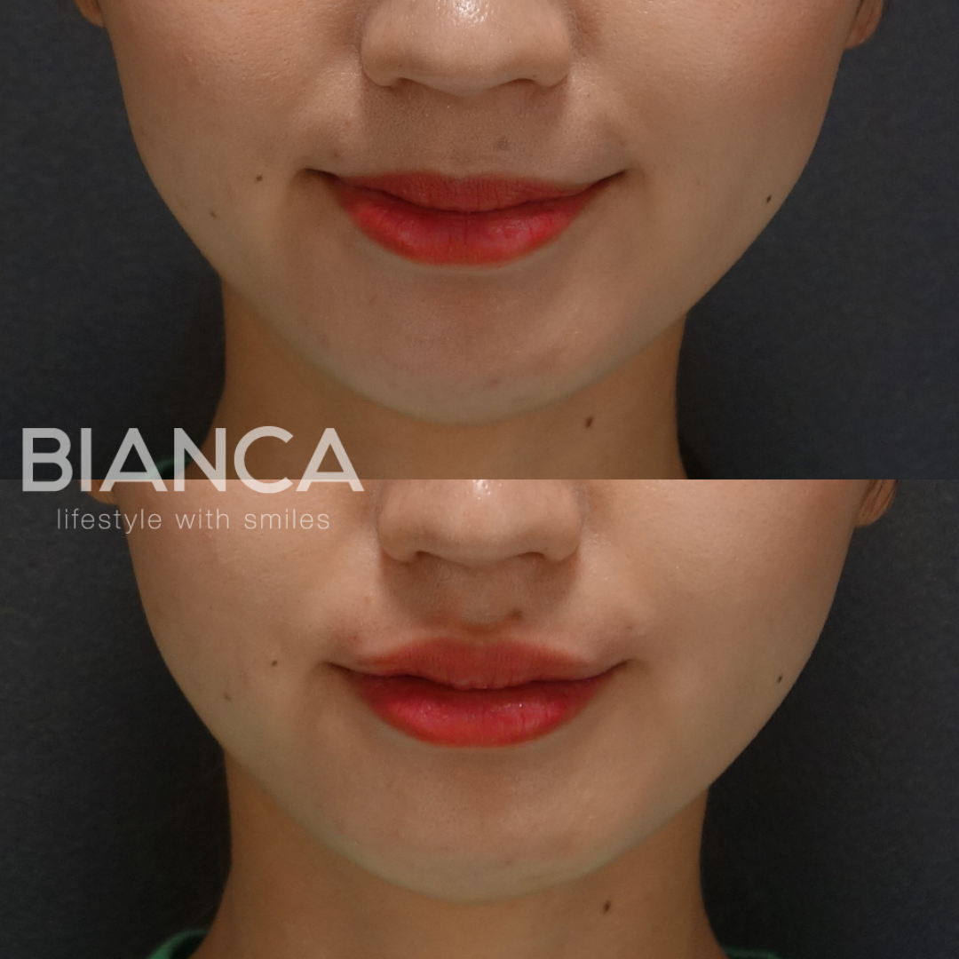 唇ヒアルロン酸で美リップに