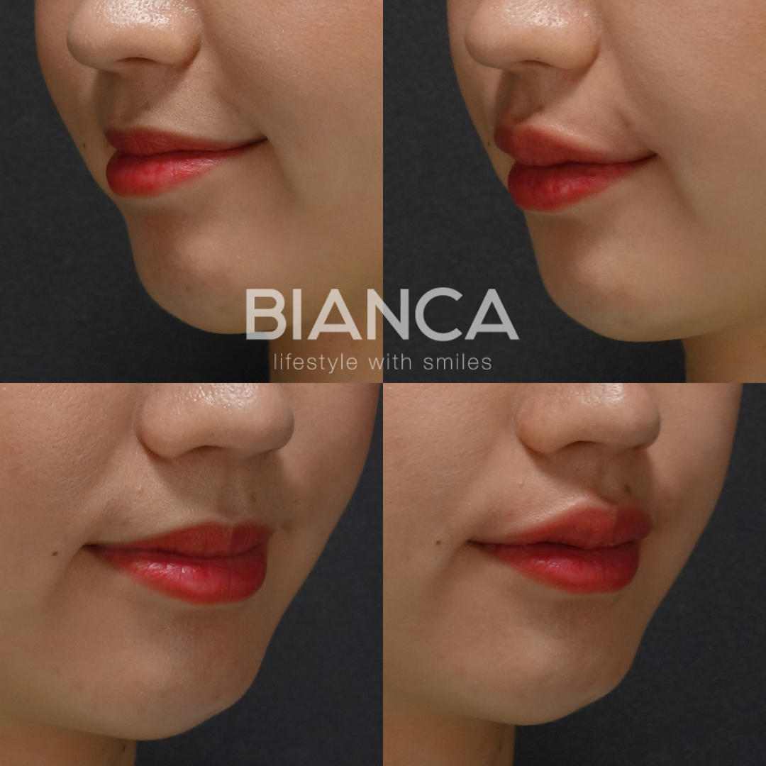 唇ヒアルロン酸でバランスのとれた美リップに