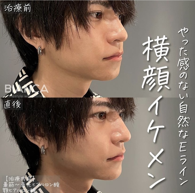 メンズヒアルロン酸