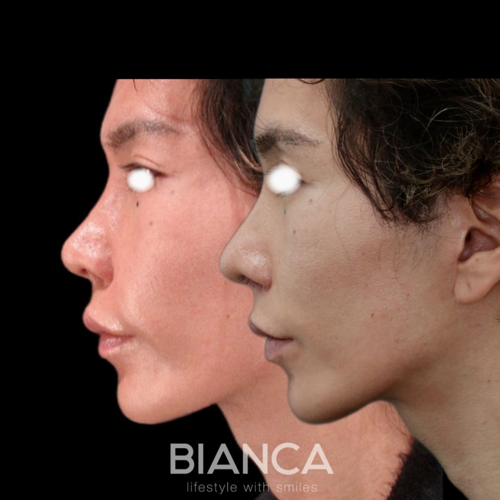 男性の鼻整形　その2