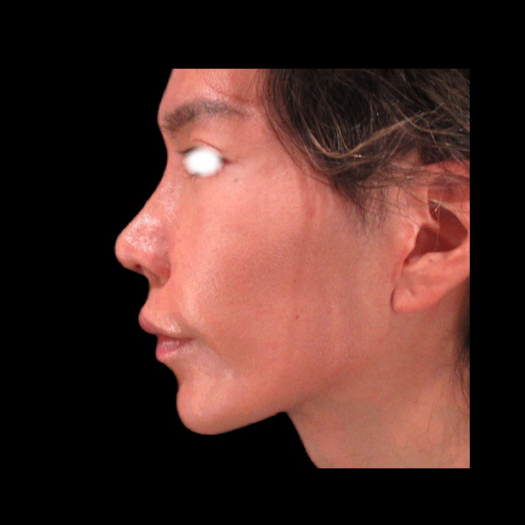 男性の鼻整形