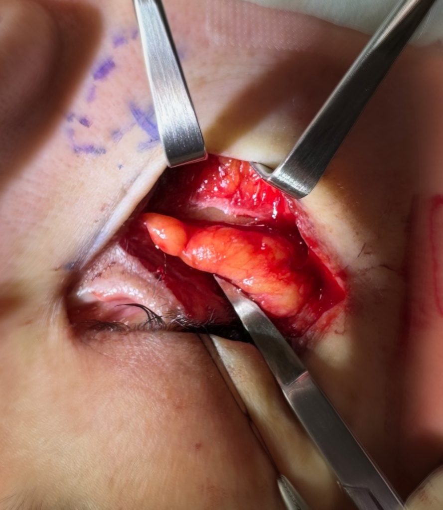 My lower blepharoplasty technique