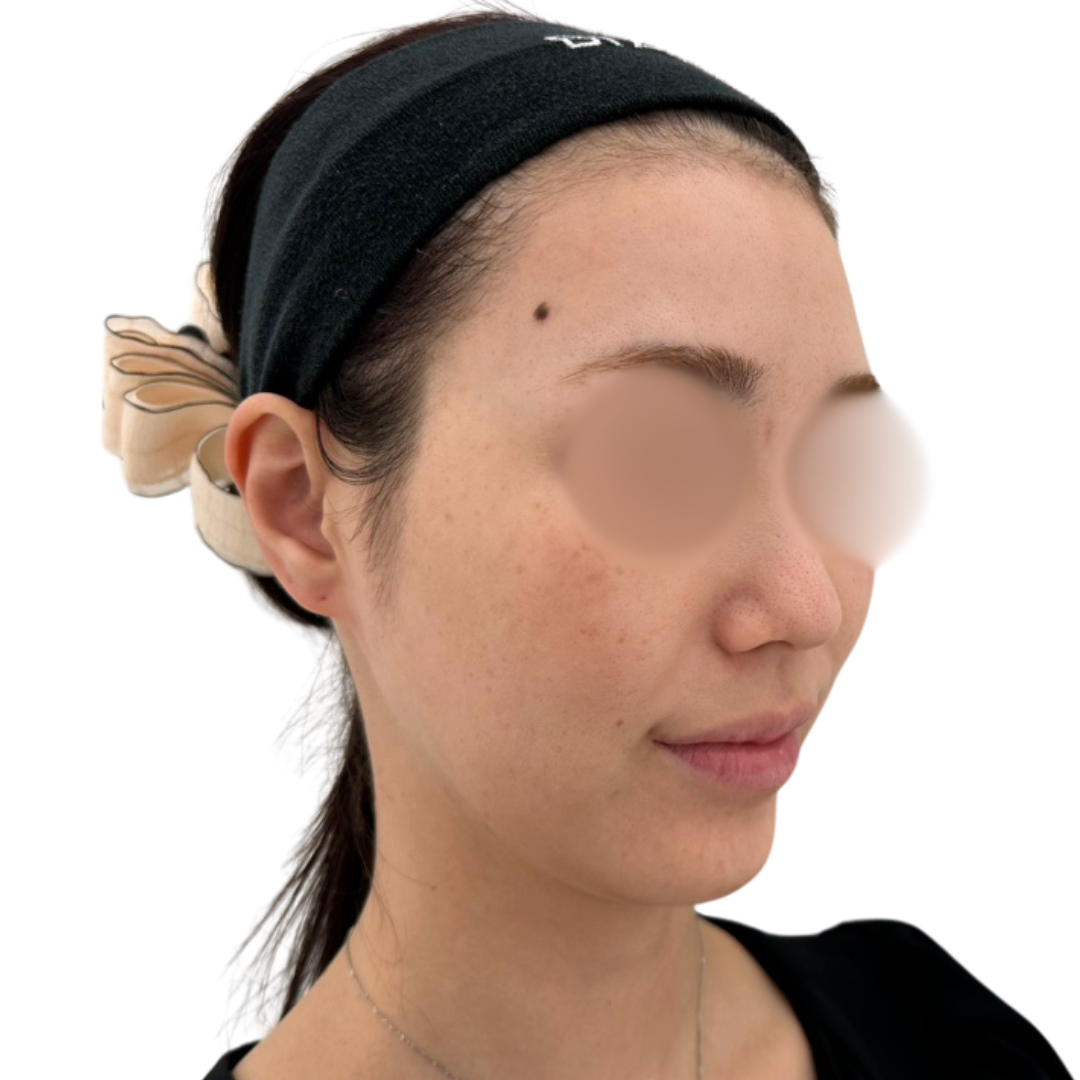 プロフェッショナルピール