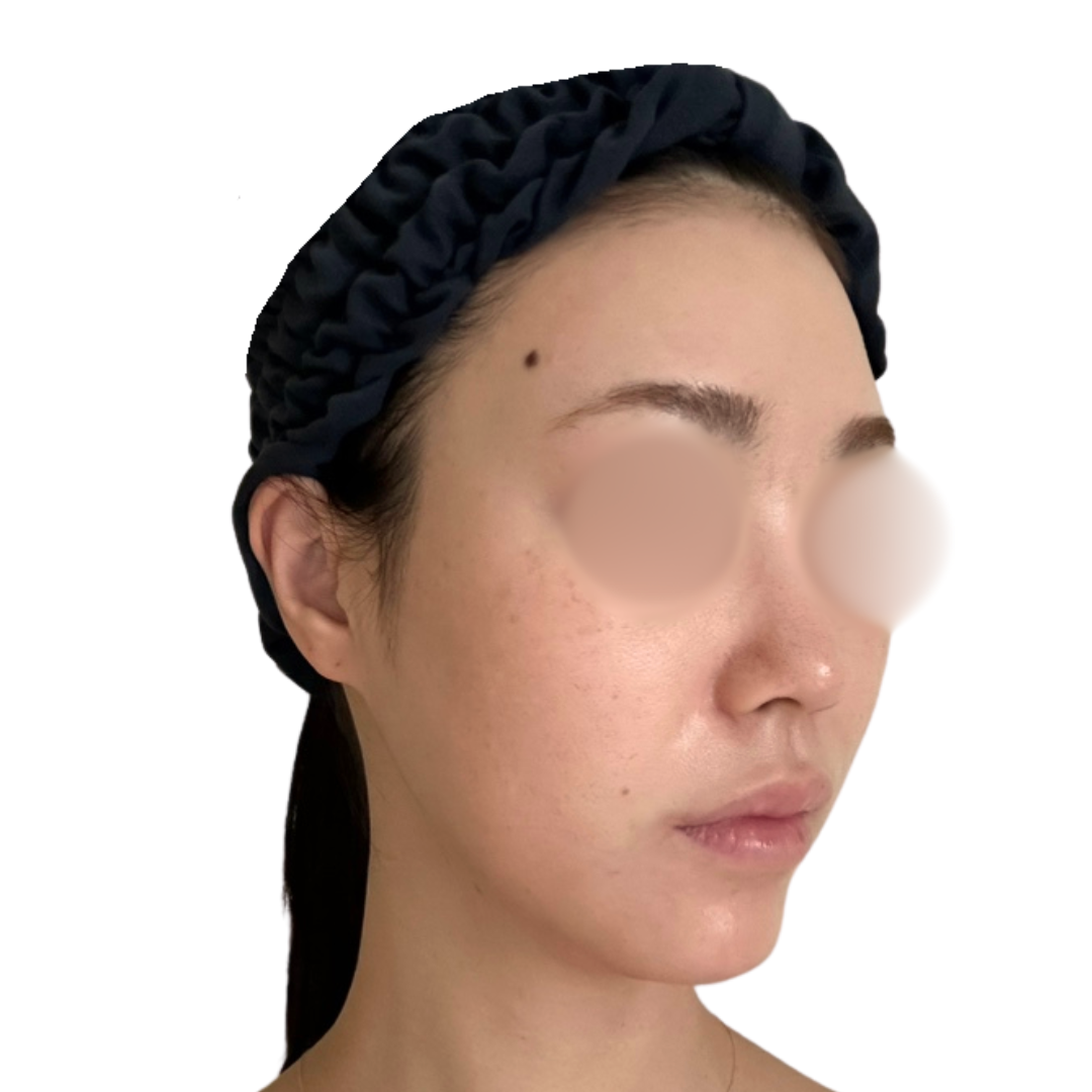 プロフェッショナルピール