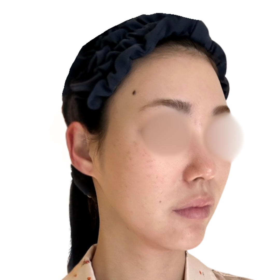 プロフェッショナルピール