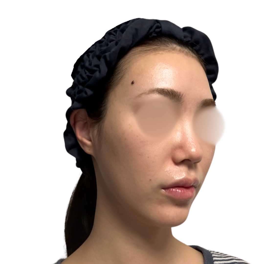 プロフェッショナルピール