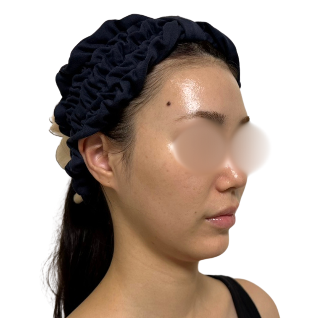 プロフェッショナルピール