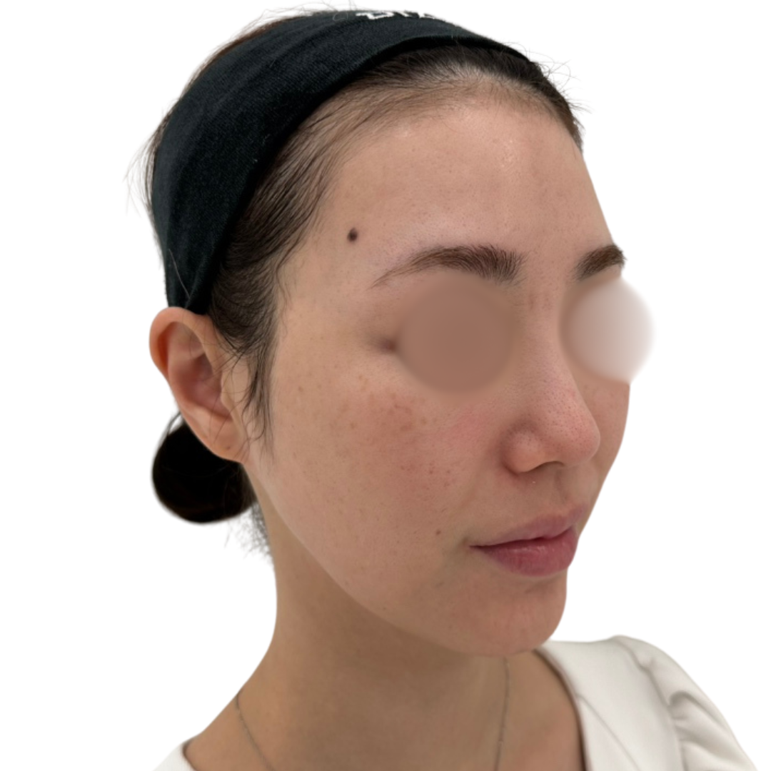 プロフェッショナルピール