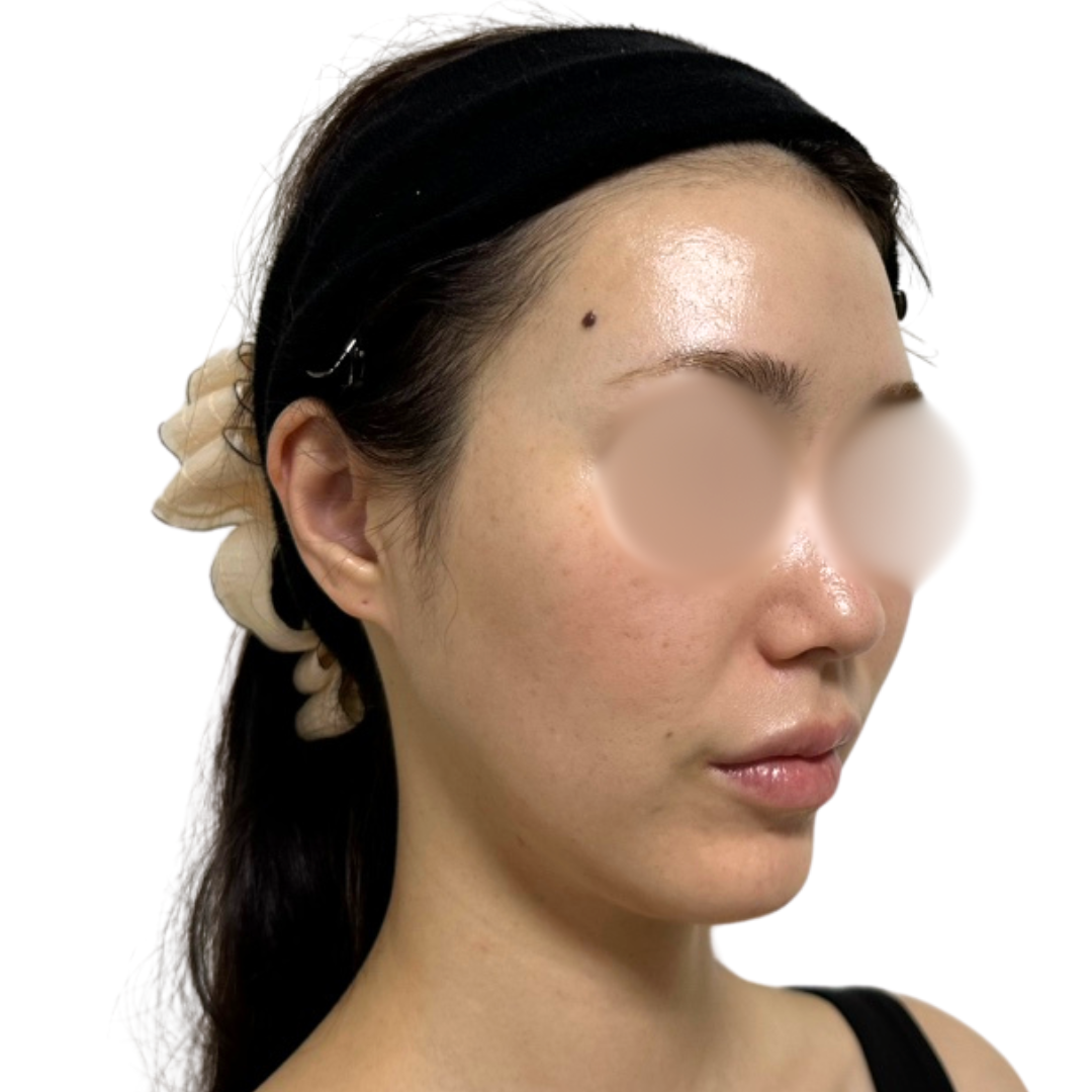 プロフェッショナルピール