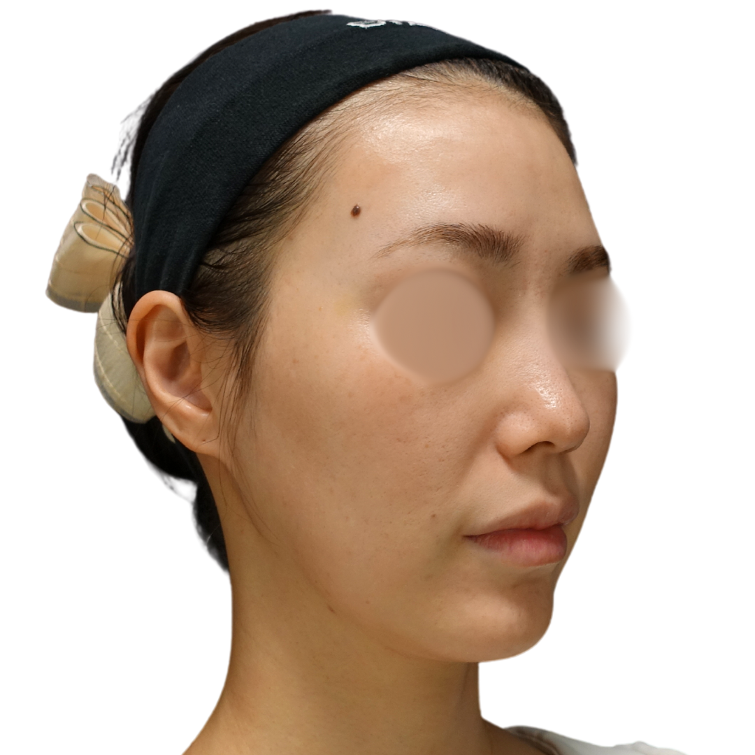 プロフェッショナルピール