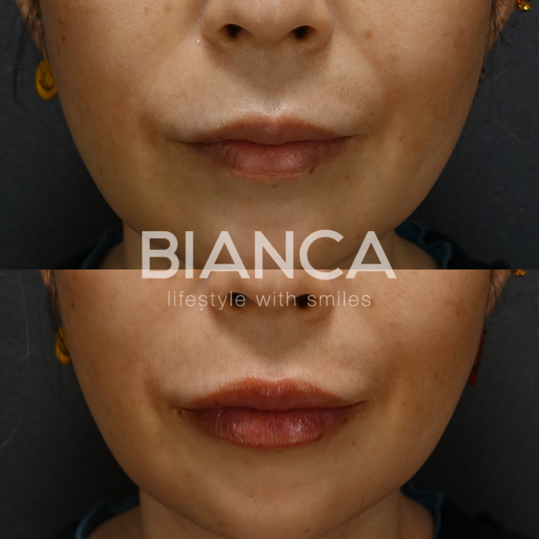 唇ヒアルロン酸