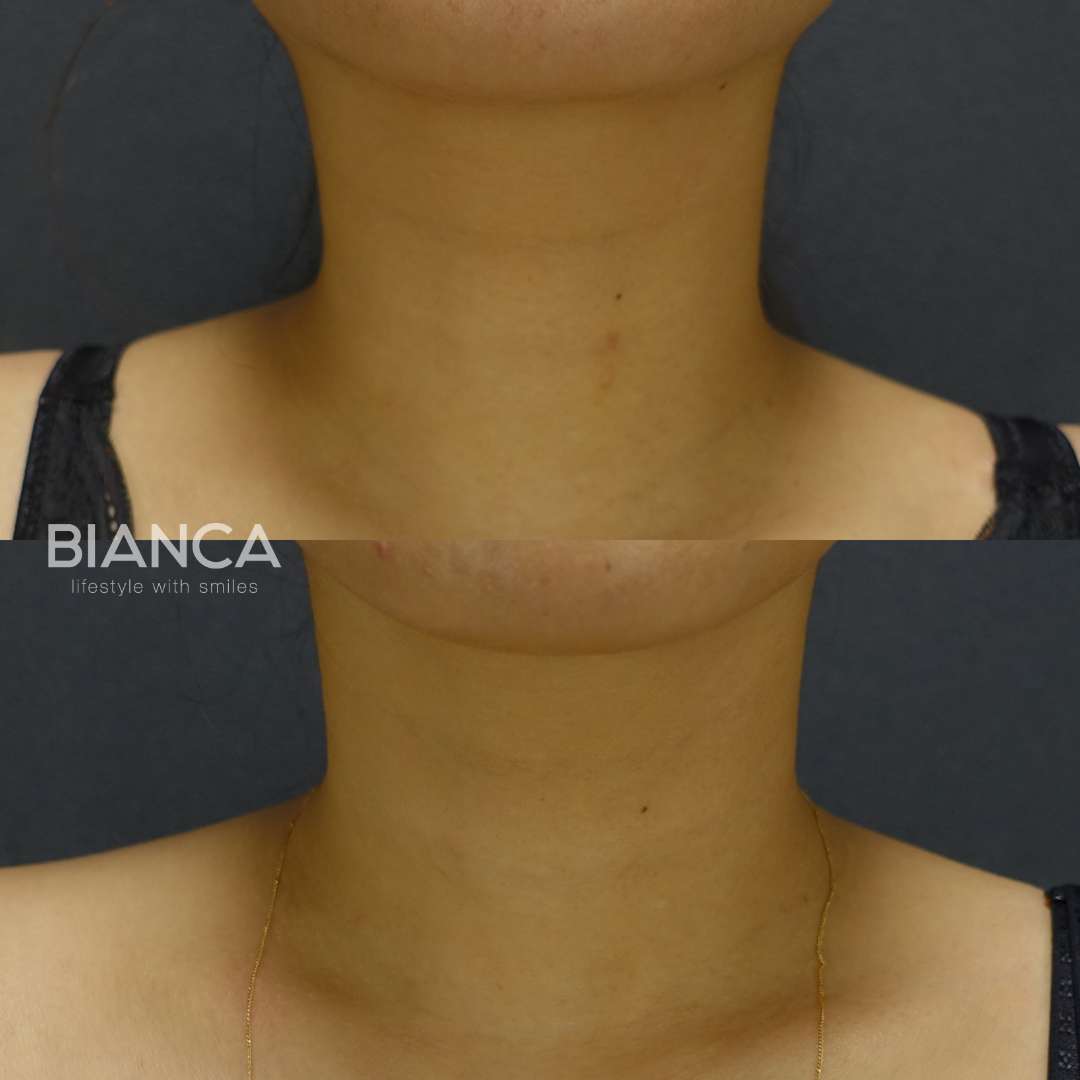 首のシワ撃退！架橋ヒアルロン酸「Volite」で深めのミゾを非架橋ヒアルロン酸「Hydro」で細かいシワを