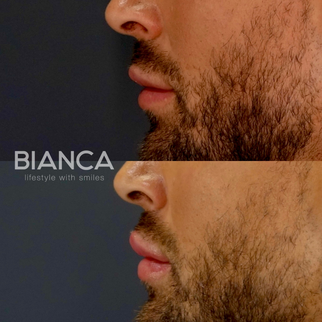 ロシアンリップ