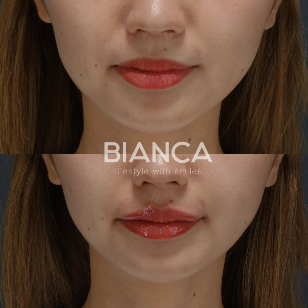 ヒアルロン酸で速攻、更なる美人へ