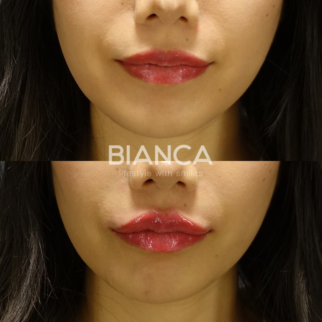 ヒアルロン酸で速攻、更なる美人へ