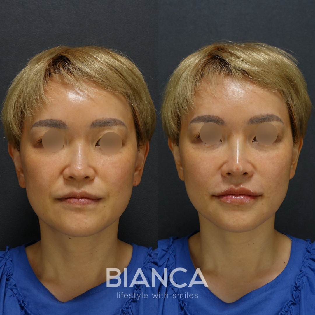 ヒアルロン酸でパンプをなくす