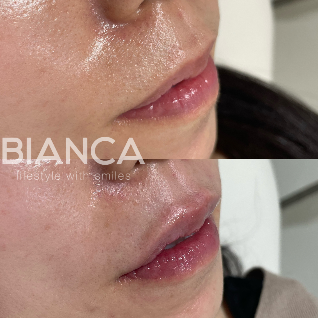 唇ヒアルロン酸