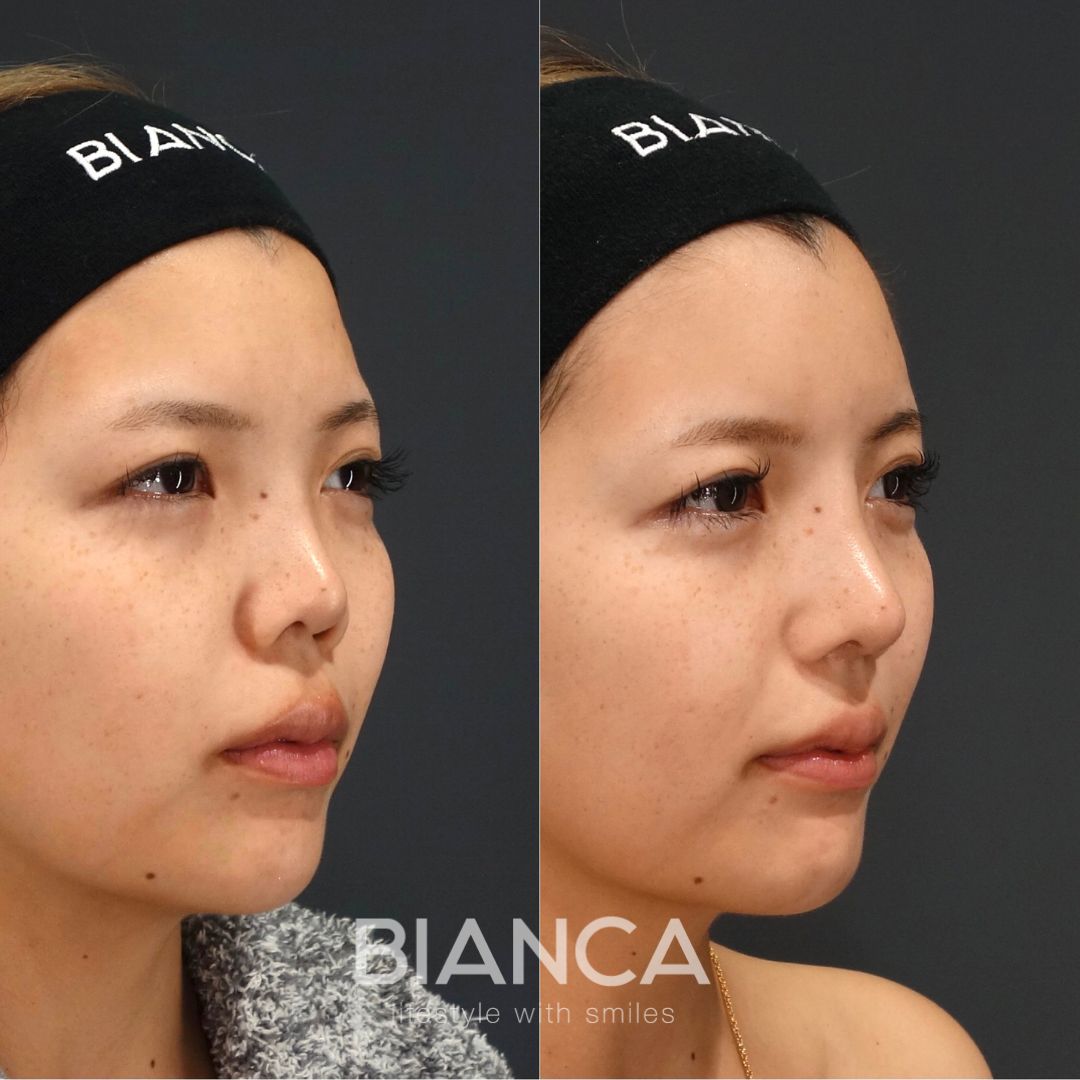 激変でもバレない鼻整形 | 日本を代表する美容健康再生医療のクリニック｜BIANCAGINZA