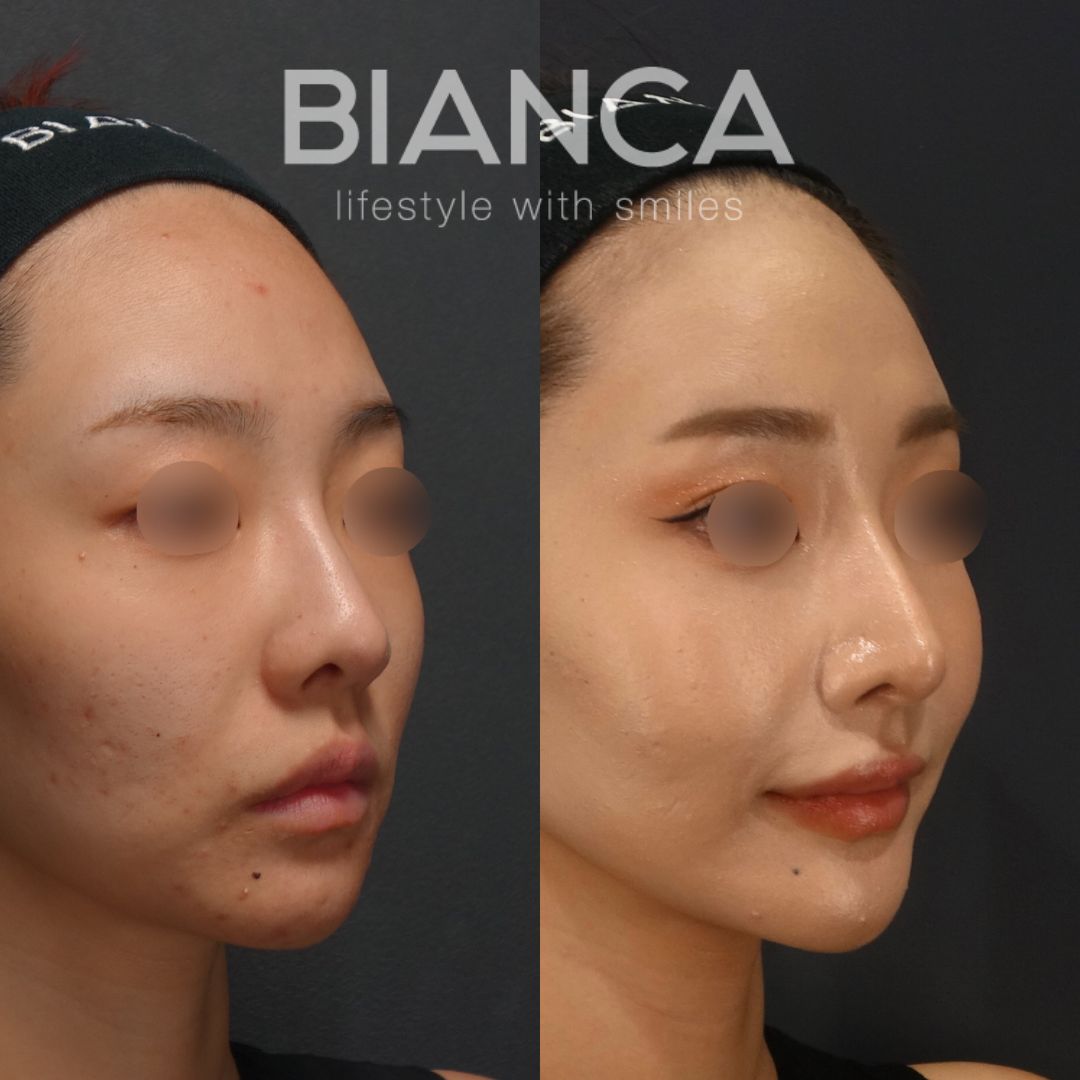 鼻柱を伸ばし、鼻先を整える | 日本を代表する美容健康再生医療のクリニック|BIANCAGINZA