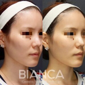 症例_頬コケヒアルロン酸