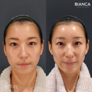 立ち耳ヒアルロン酸注射の症例_正面