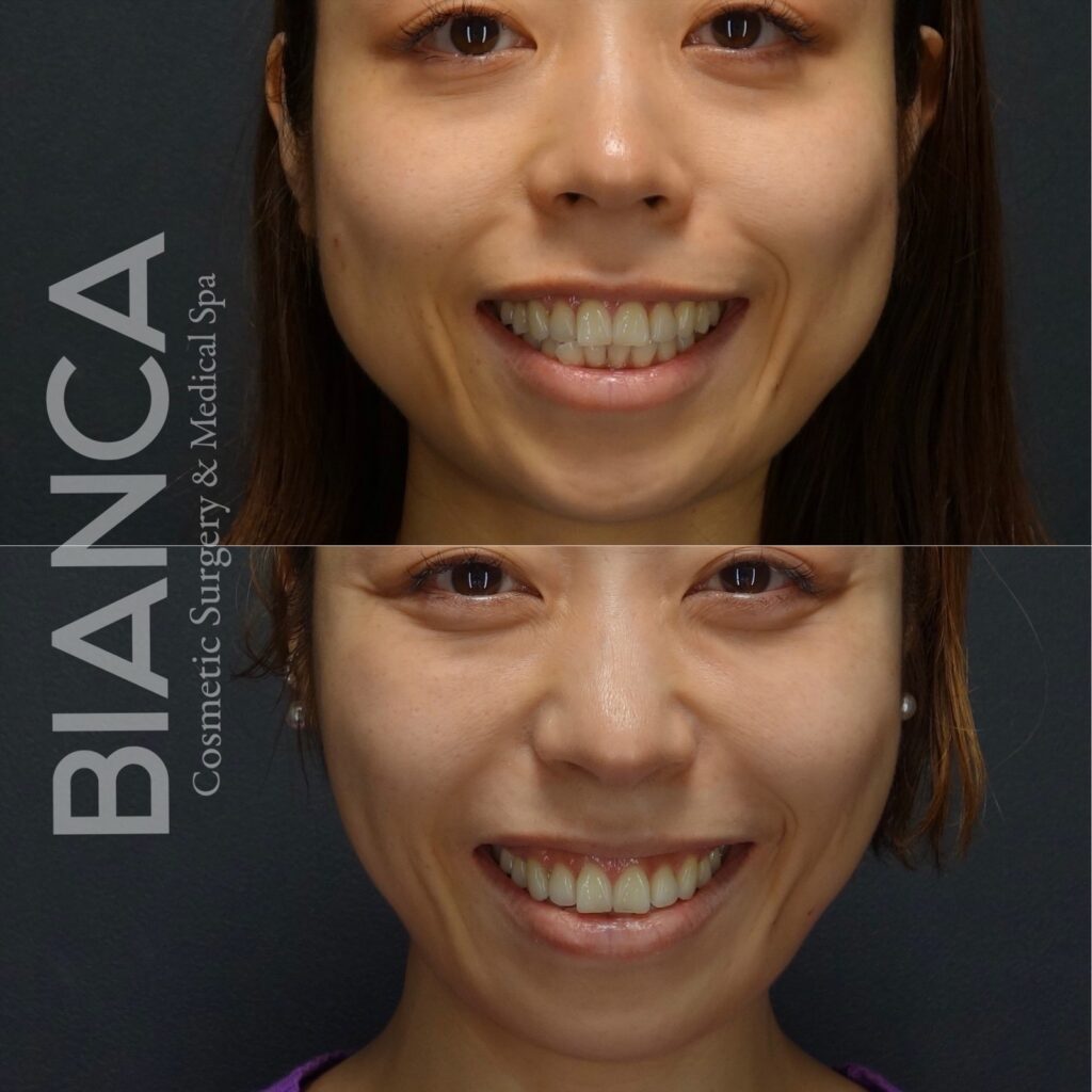 エラボトックスで失敗しないために！知っておきたい原因と対策