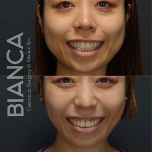 エラボトックスで失敗しないため知っておきたい原因と対策｜ビアンカ銀座｜日本を代表する美容健康再生医療のクリニック