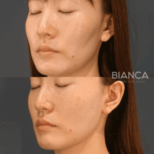 頬コケヒアルロン酸_症例