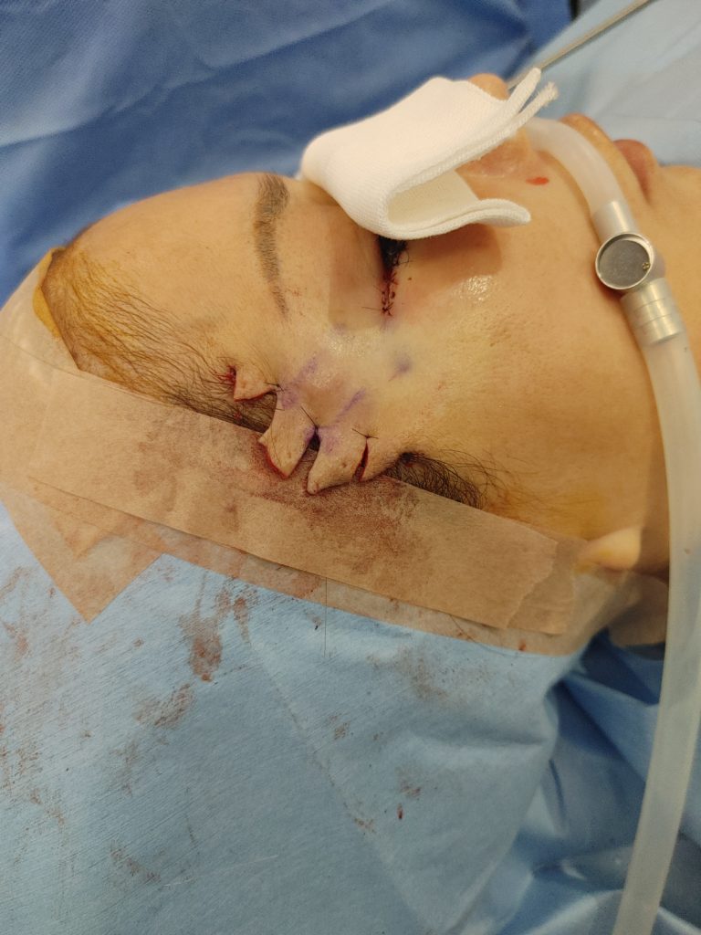 こみかみリフト　直後