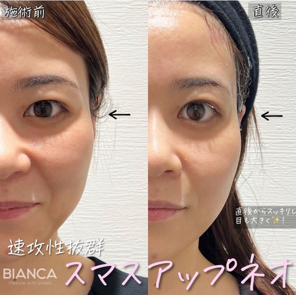 大人気速攻！小顔治療『スマスアップネオ』😊