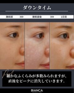 リジュラン_ダウンタイム_ビフォーアフター